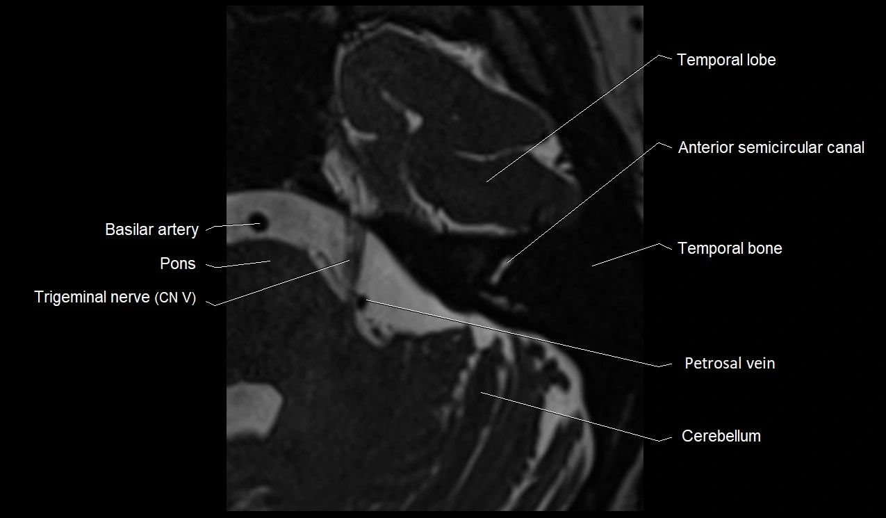 Internal auditory canal (IAC) axial cross sectional anatomy image 27.webp